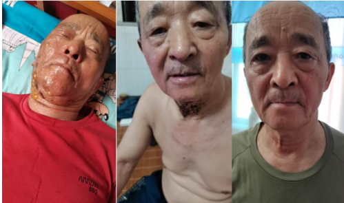 百草凝香守初心 古法新承惠万家——记基层民间中医代表唐玉琼与她的京华瑞烫伤膏